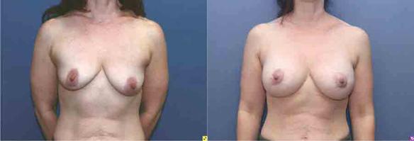 breast lift with breast implants